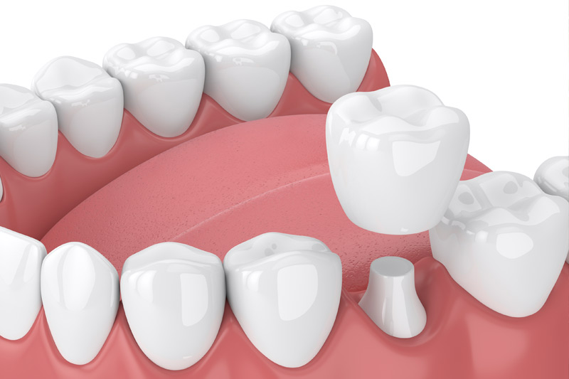Dental Crowns in Garden Grove