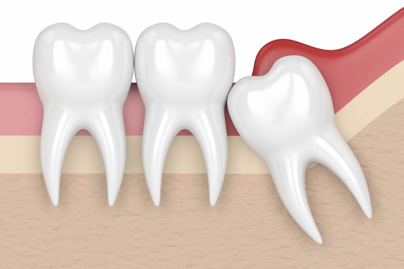 Wisdom Tooth Removal in Garden Grove